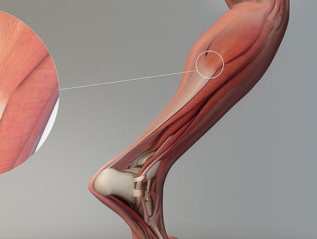 Tendon Ruptures