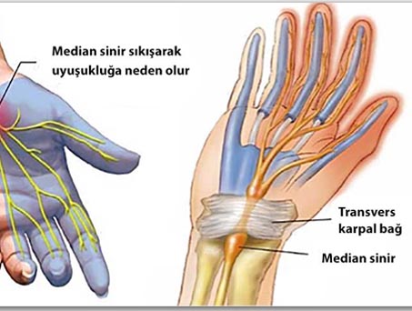 Carpal Tunnel Syndrome