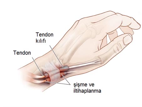 De Quervain's Tendinitis