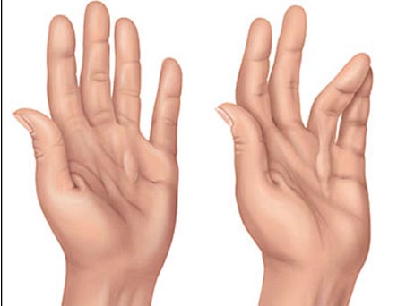 Dupuytren's Contracture