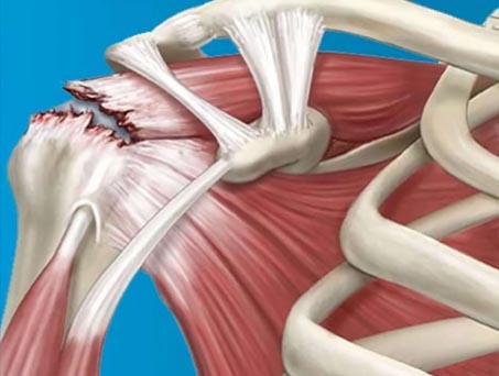 Rotator Manşet Yaralanması