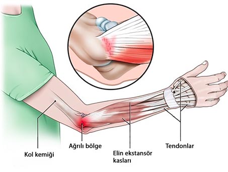 Tenisçi Dirseği	