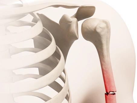Humerus Kırığı
