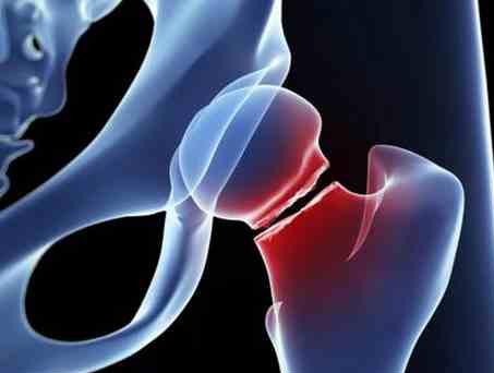 Femur Kırığı